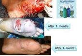 Revolutic Biospray Bantu Sembuhkan Penyakit Kronis
